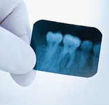 Impacted Wisdom Teeth: Symptoms, Types & Removal