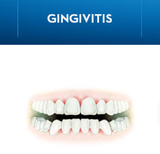 What is Gingivitis? Symptoms, Causes, and Treatments What is Gingivitis? Symptoms, Causes, and Treatments