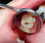 Can cavities go away on their own? Can cavities go away on their own?